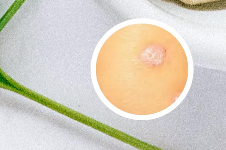 生孩子后，我的银屑病变得更严重了该怎么办