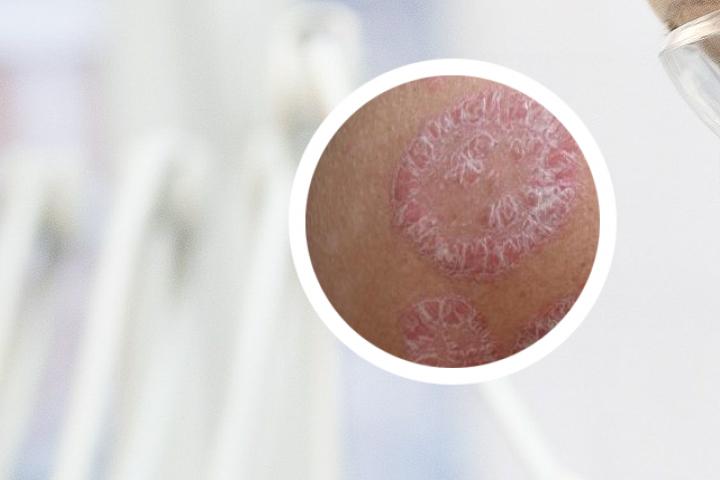艾草熬水洗治疗银屑病案例