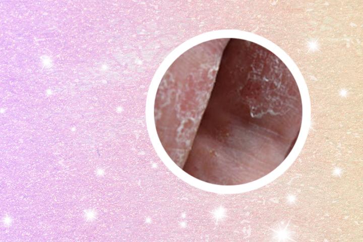 牛皮癣可以通过真菌检查出来吗
