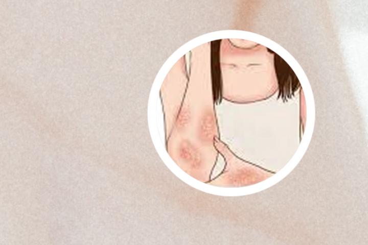 牛皮癣会引起耳聋
