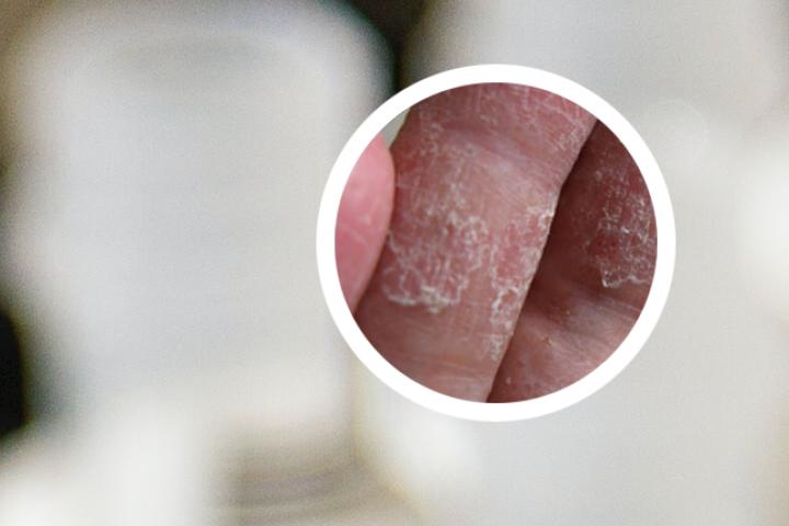 银屑病吃阿维a多久见效