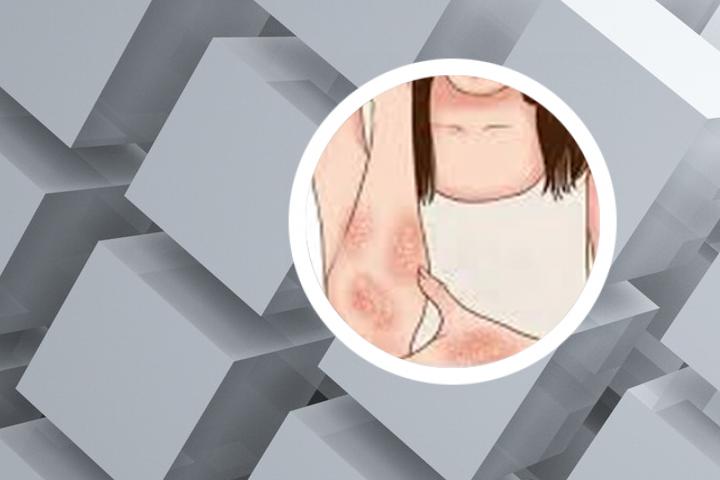 土楼万应膏可以治银屑病吗