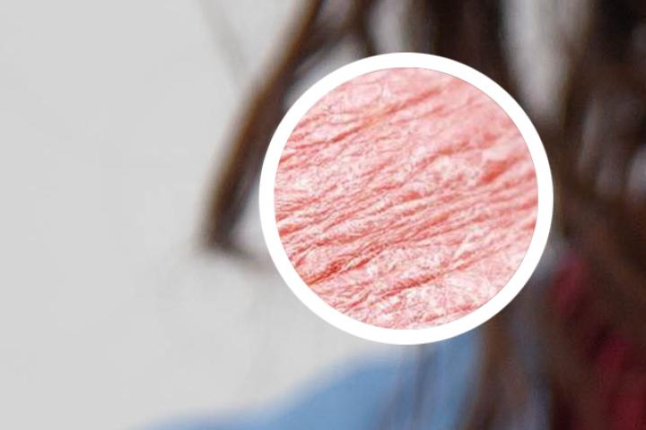 300元治好银屑病