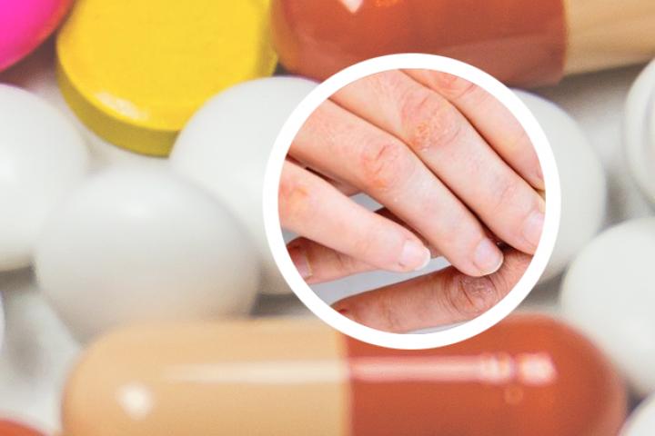 小孩子得银屑病