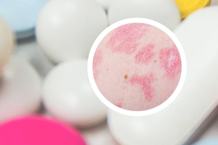 牛皮癣用红小豆能治吗