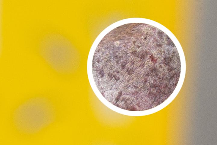 银屑病泡脚图片高清