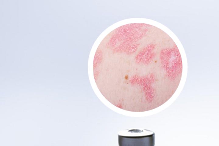 治疗牛皮癣医保能报销吗