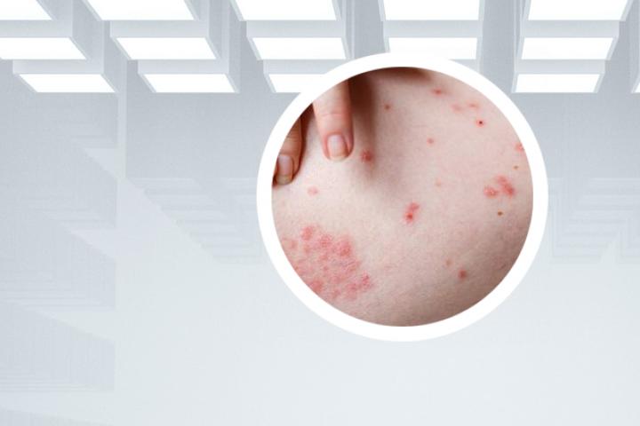Hiv感染后银屑病