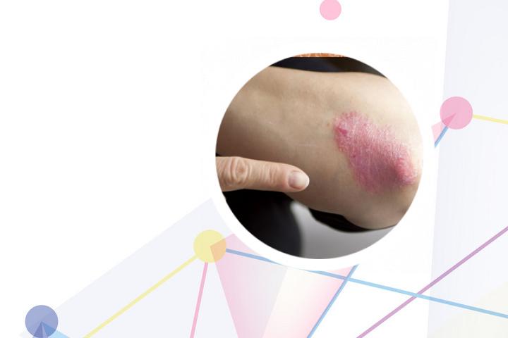 银屑病 单抗 价格