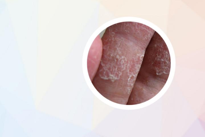 牛皮癣为什么变裂