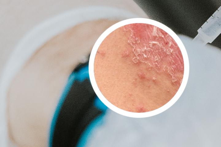 牛皮癣症状腿部图片