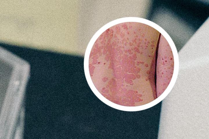 银屑病如何痊愈