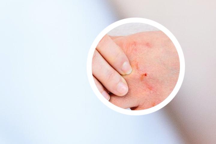 牛皮癣患者沐浴露