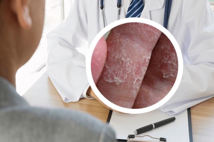 牛皮癣深红色腿不了