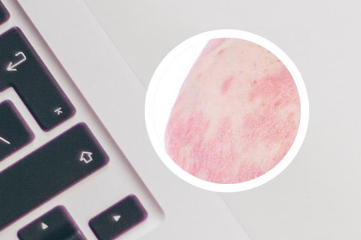 mtx治疗银屑病有没有依赖性