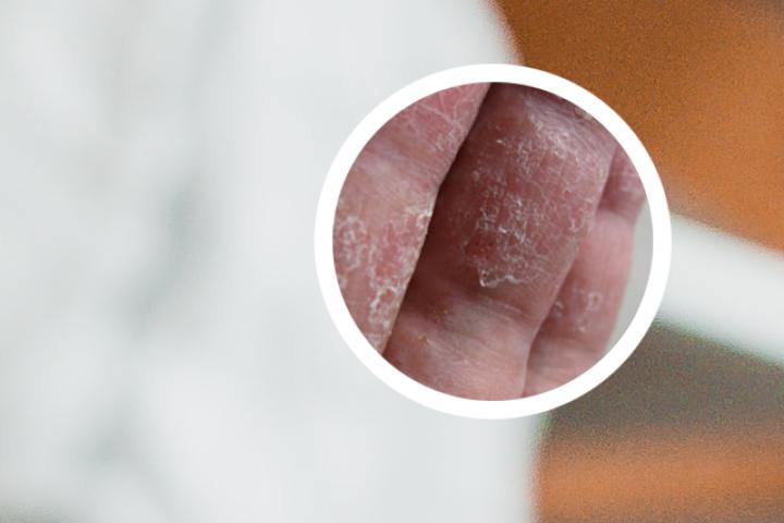请问治疗银屑病哪种药膏效果比较好