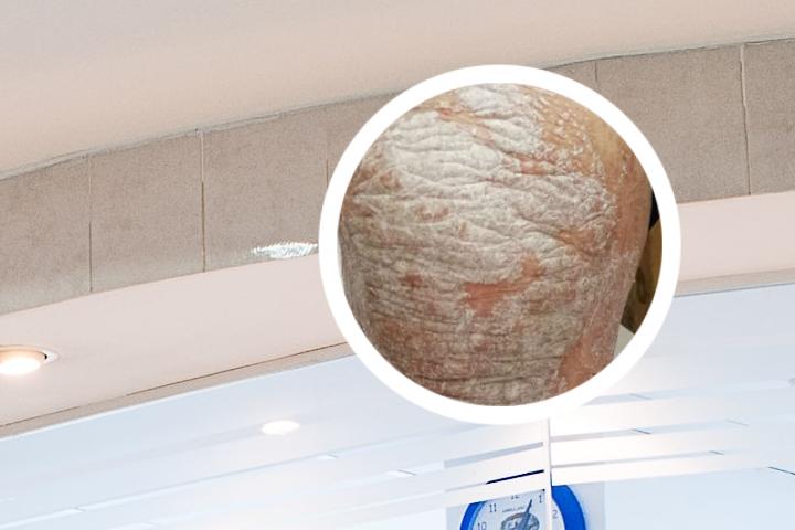 311光疗治疗银屑病怎么样