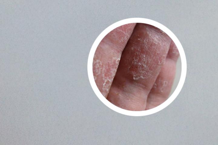 银屑病搽什么止痒