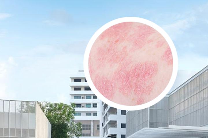 银屑病的克星是什么