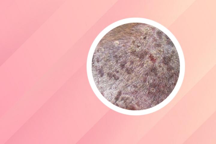 枸杞子治牛皮癣么