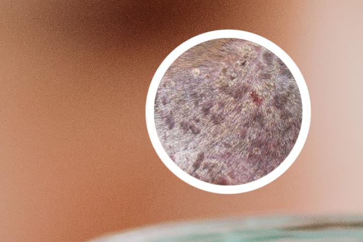 杉树汁能不能治疗牛皮癣