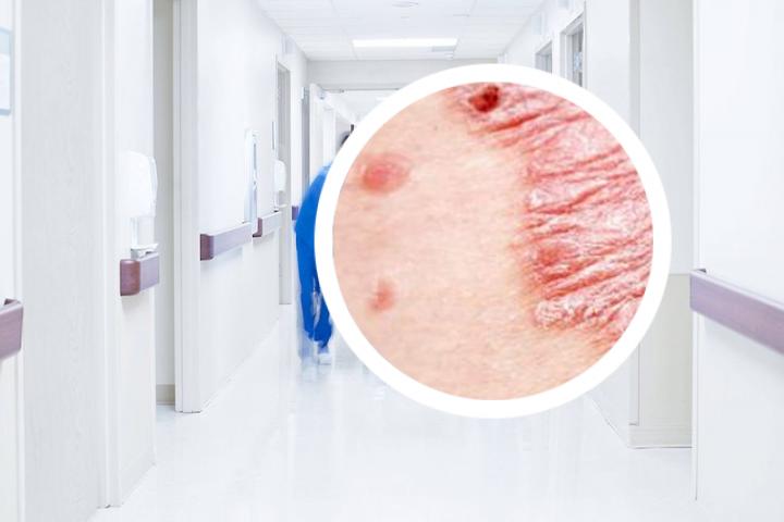 白醋水可以洗银屑病