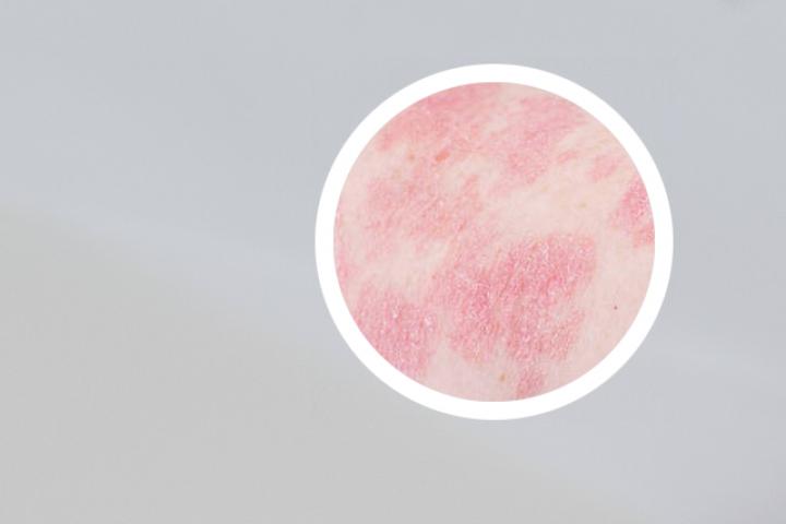 抗人白介素银屑病效果