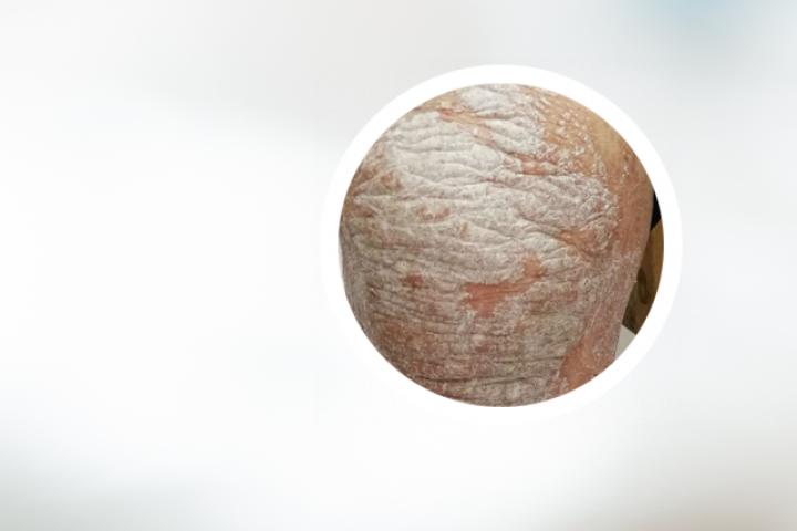 银屑病终身不复发的案例