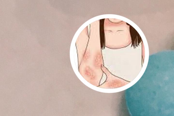 淄博淄川治牛皮癣