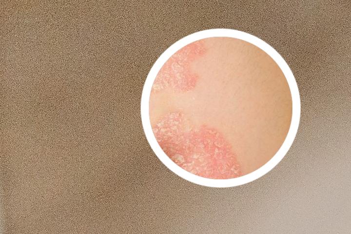 斑蝥雄黄治牛皮癣