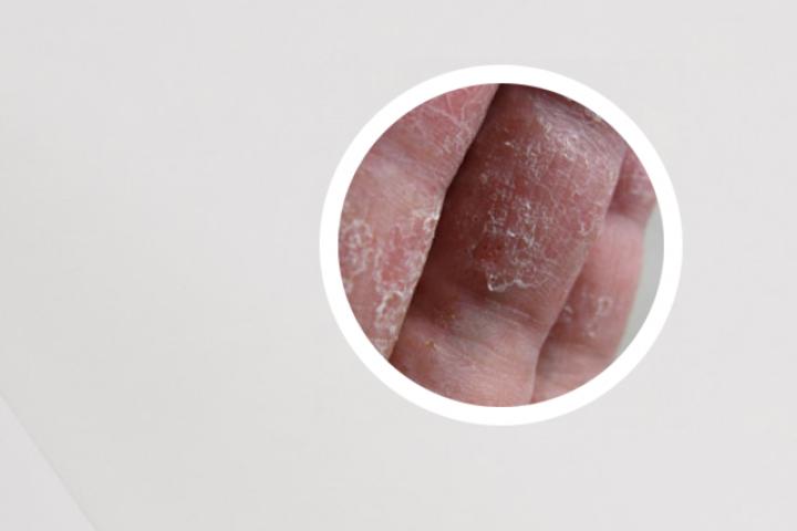 克银丸对银屑病有用吗