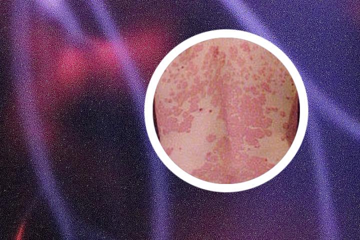 阿司匹林治疗银屑病