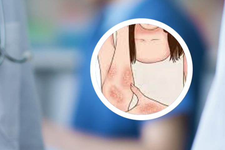 银屑病患者每天吃两个猕猴桃有助于改善病情吗