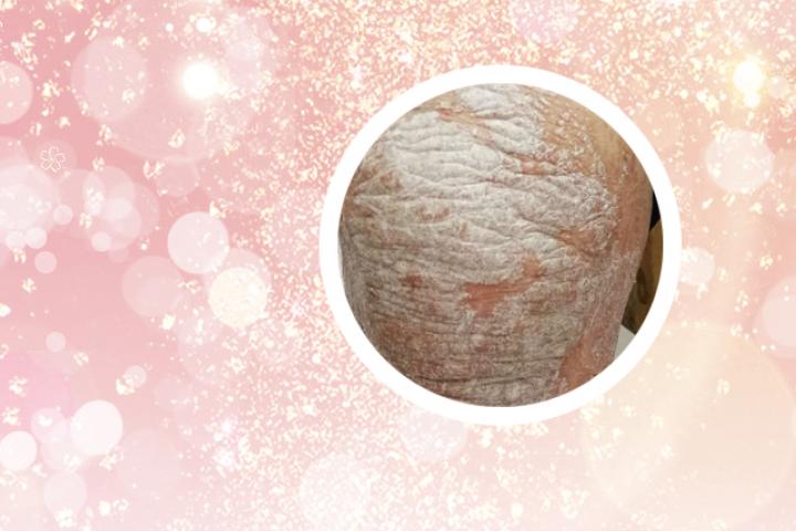小苏打水去除牛皮癣