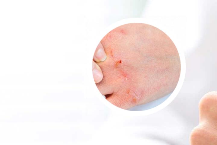 牛皮癣痒又红点