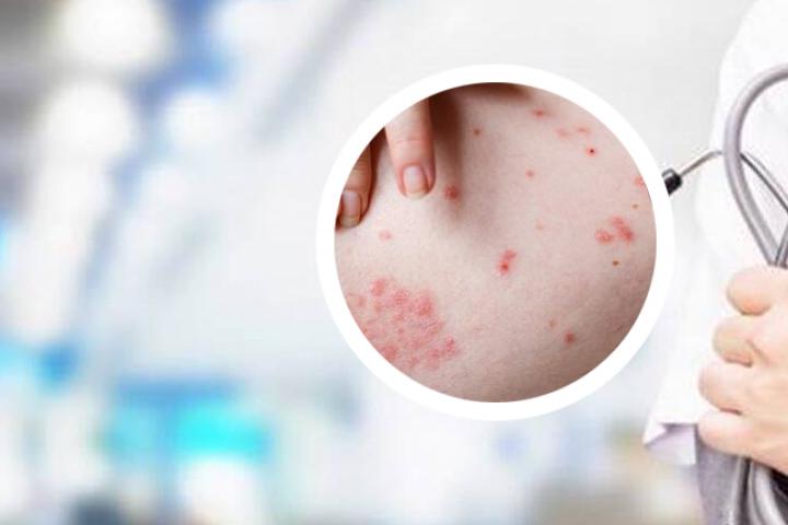 掌趾脓疱疮和银屑病是否有关联