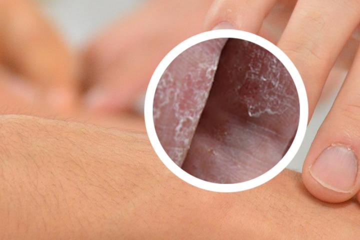 牛皮癣的治疗方法