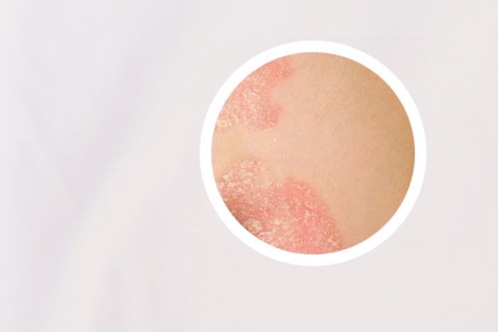 银屑病吃什么药效果最好