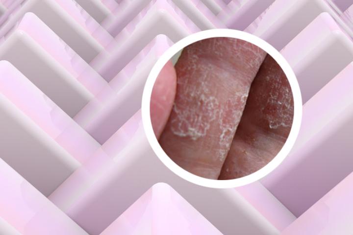 牛皮癣患者睡醒双眼肿起来