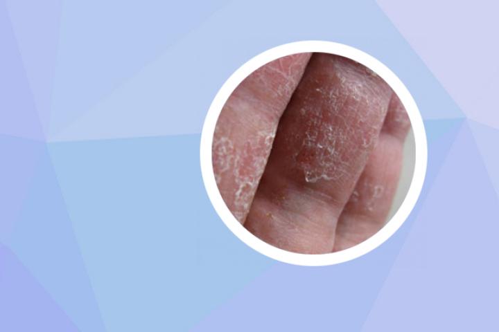 如何区分玫瑰糠疹和副银屑病