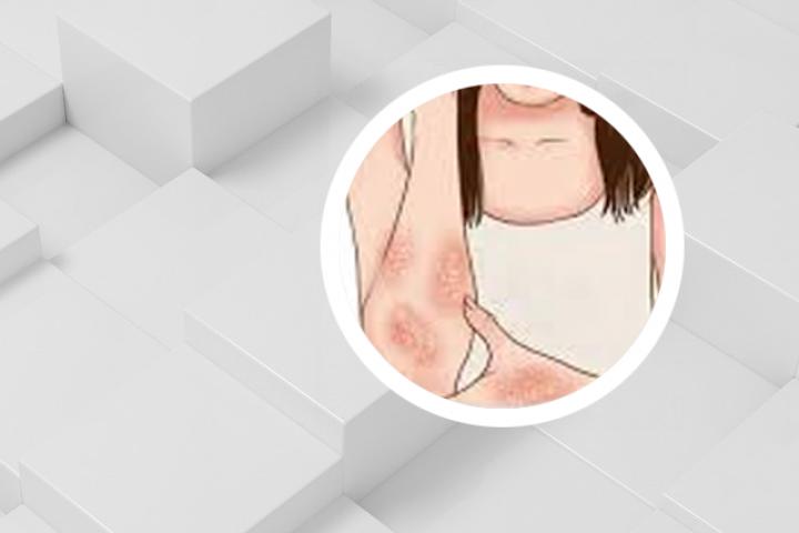 地板上长出银屑病图片真实