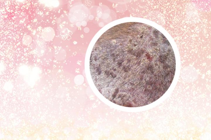 菝葜可治银屑病吗