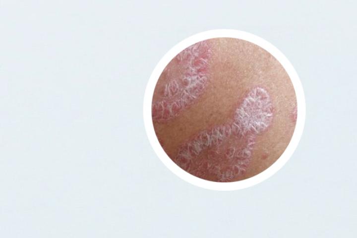 阿奇霉素对银屑病有用吗