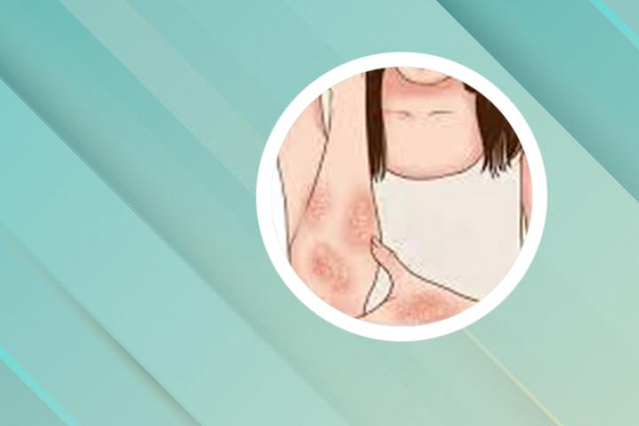 银屑病需做什么检查