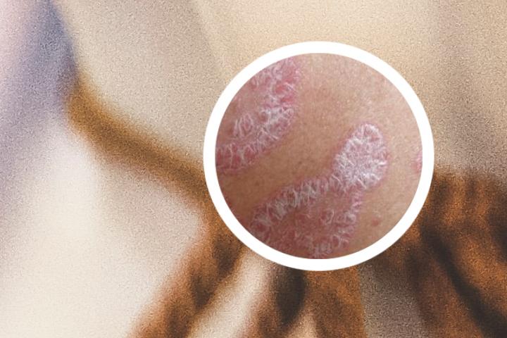 银屑病是种什么病毒
