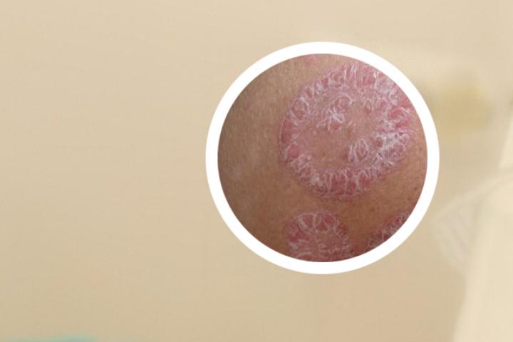 我跑步治好了银屑病