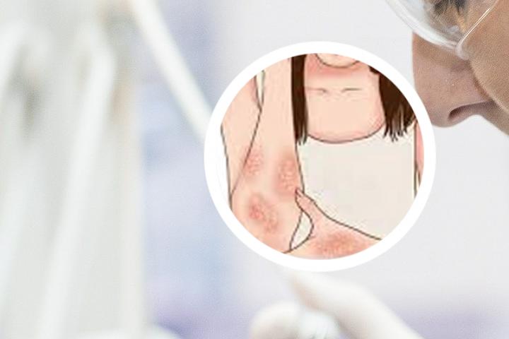 阿维a胶囊治疗银屑病的原理