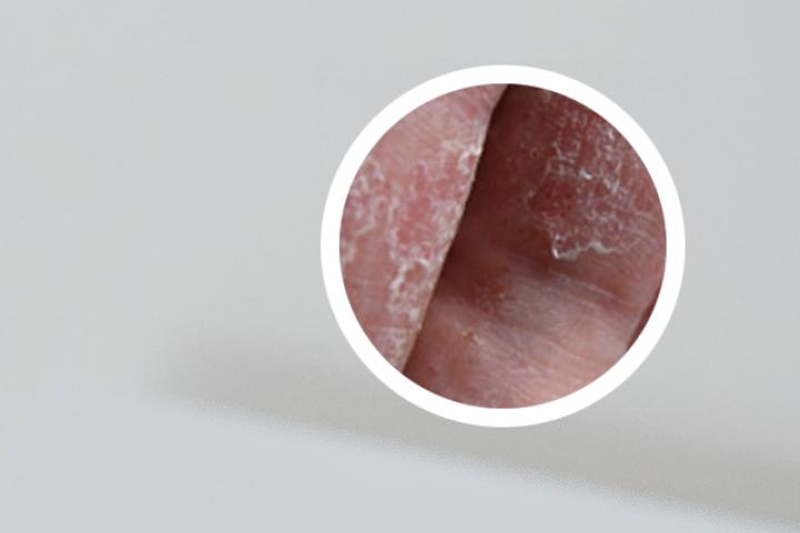 喜树碱软膏能否治愈银屑病