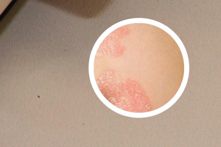 银屑病的患者能吃西瓜吗