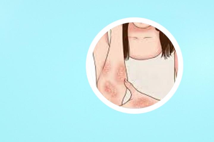 牛皮癣疫苗进展